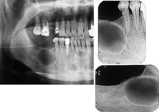 Odontogeninė keratocista